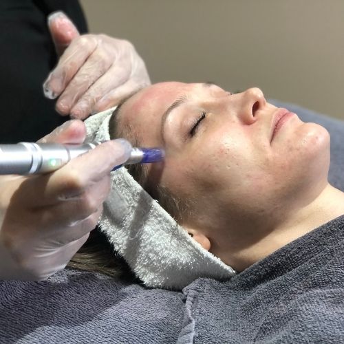 Microneedling & the importance of Collagen