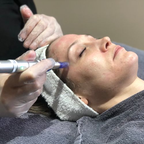 The 411 on Microneedling
