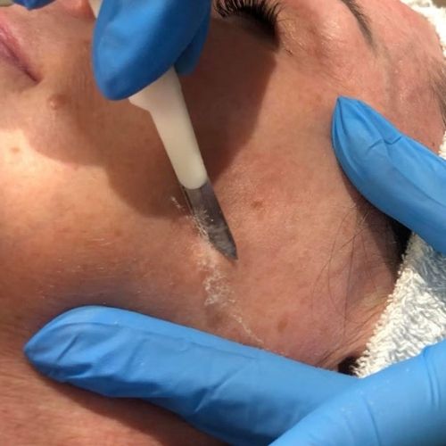Down and dirty with Dermaplaning
